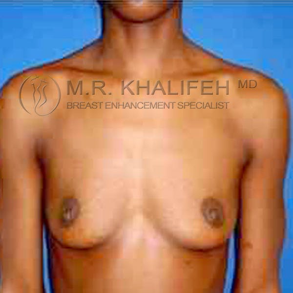 Breast Augmentation Gallery - Patient 3762368 - Image 1
