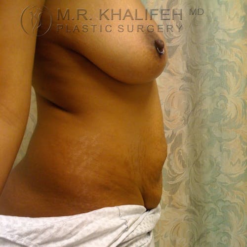 Tummy Tuck Gallery - Patient 3762369 - Image 3