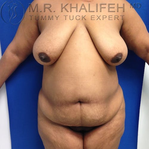 Tummy Tuck Gallery - Patient 3762374 - Image 1