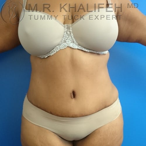 Tummy Tuck Gallery - Patient 3762374 - Image 2