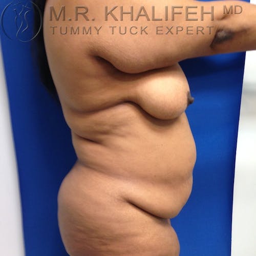 Tummy Tuck Gallery - Patient 3762374 - Image 5