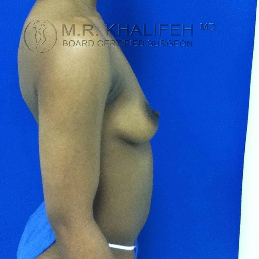 Breast Augmentation Gallery - Patient 3762377 - Image 7
