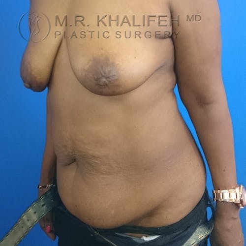 Tummy Tuck Gallery - Patient 3762381 - Image 5
