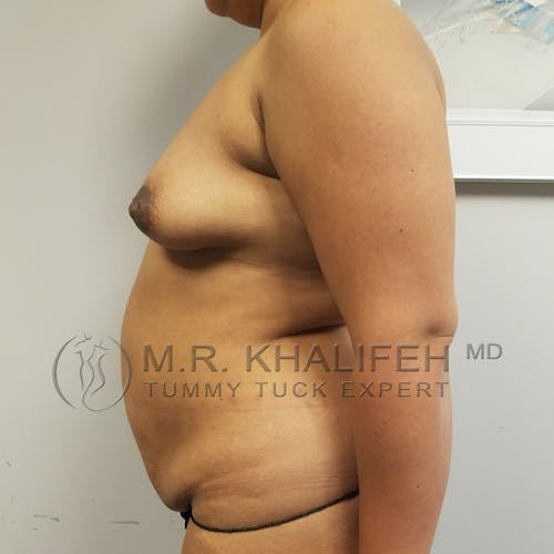 Tummy Tuck Gallery - Patient 3762386 - Image 7