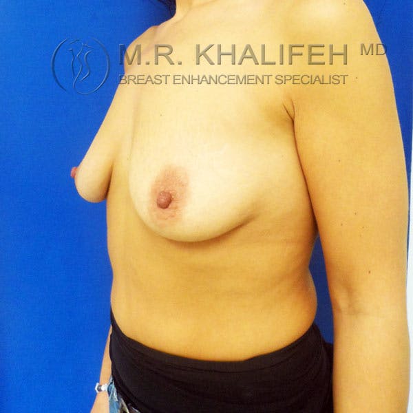 Breast Augmentation Gallery - Patient 3762384 - Image 9