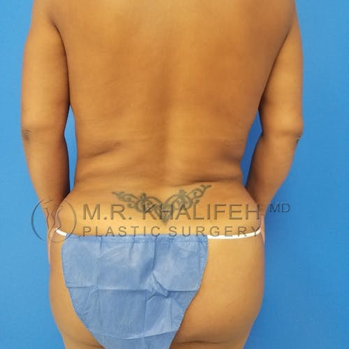 Tummy Tuck Gallery - Patient 3762391 - Image 8