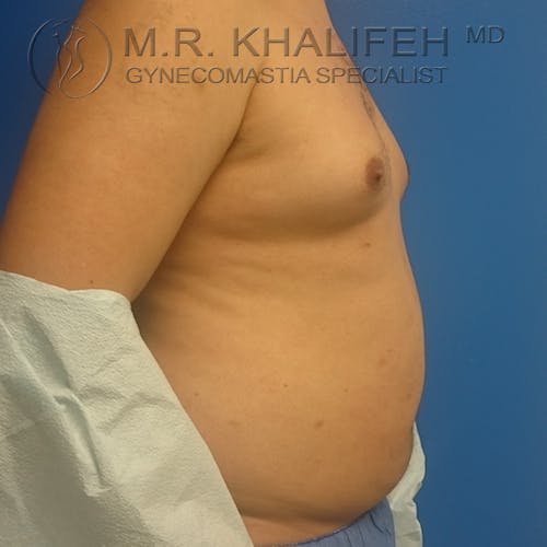 Gynecomastia Gallery - Patient 3762392 - Image 8