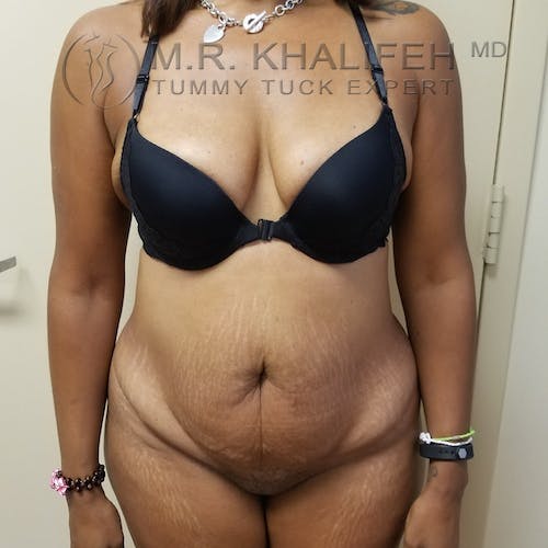Tummy Tuck Gallery - Patient 3762396 - Image 1