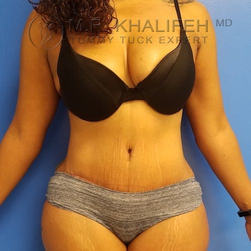 Tummy Tuck Gallery - Patient 3762396 - Image 2