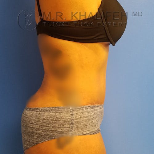 Tummy Tuck Gallery - Patient 3762396 - Image 4