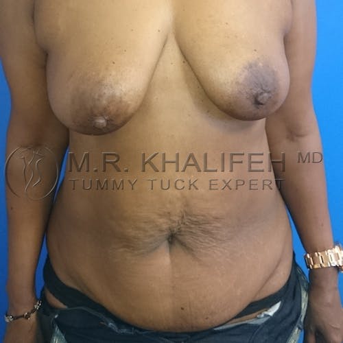 Tummy Tuck Gallery - Patient 3762400 - Image 1