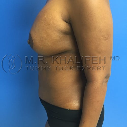 Tummy Tuck Gallery - Patient 3762400 - Image 8