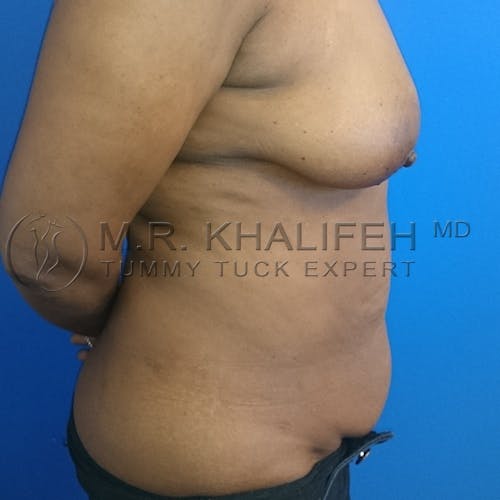 Tummy Tuck Gallery - Patient 3762400 - Image 9