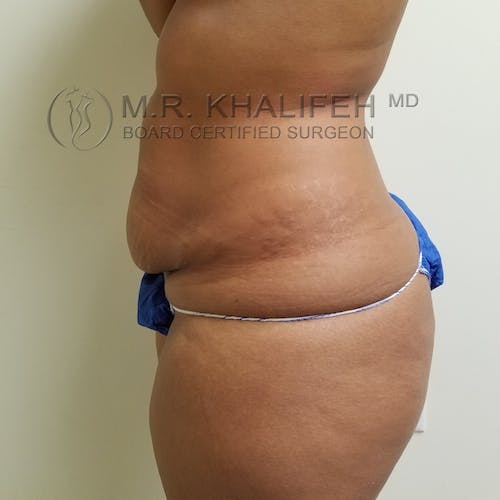 Tummy Tuck Gallery - Patient 3762405 - Image 3