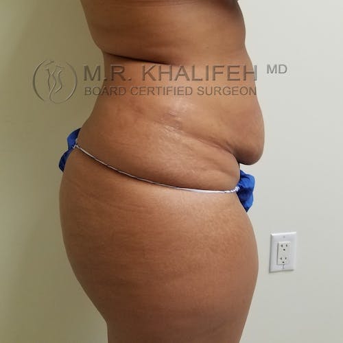 Tummy Tuck Gallery - Patient 3762405 - Image 5