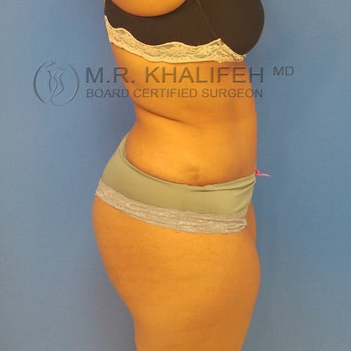 Tummy Tuck Gallery - Patient 3762405 - Image 6