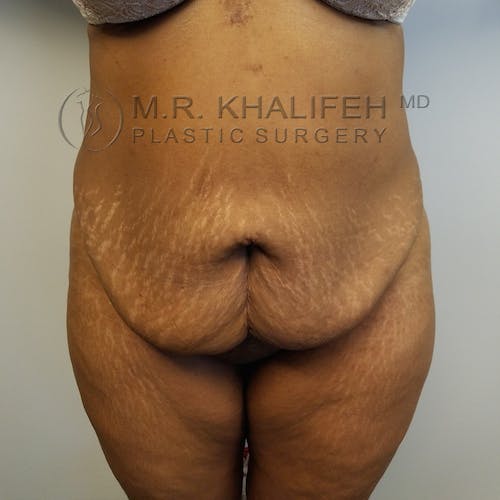Tummy Tuck Gallery - Patient 3762410 - Image 1