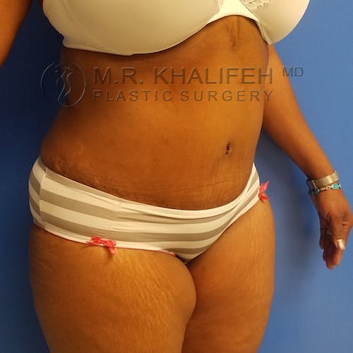 Tummy Tuck Gallery - Patient 3762410 - Image 4