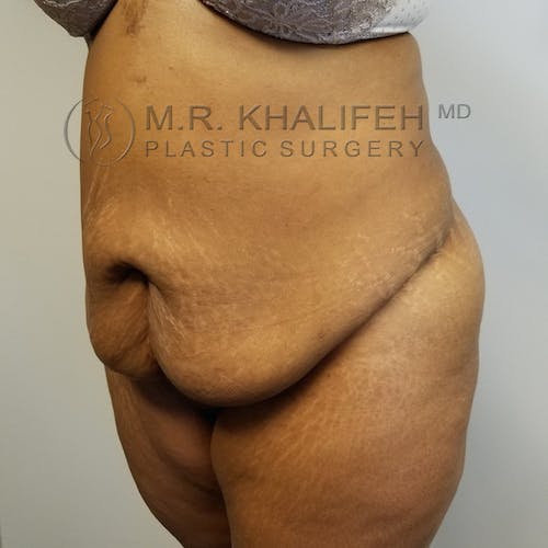 Tummy Tuck Gallery - Patient 3762410 - Image 5