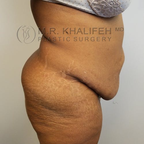 Tummy Tuck Gallery - Patient 3762410 - Image 7