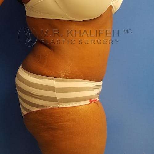 Tummy Tuck Gallery - Patient 3762410 - Image 8