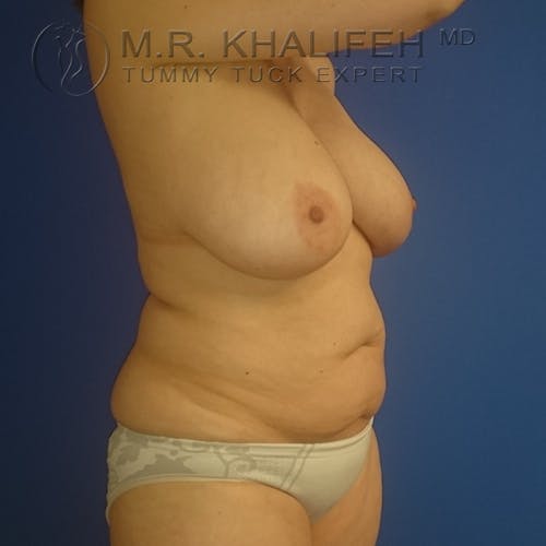 Tummy Tuck Gallery - Patient 3762414 - Image 3