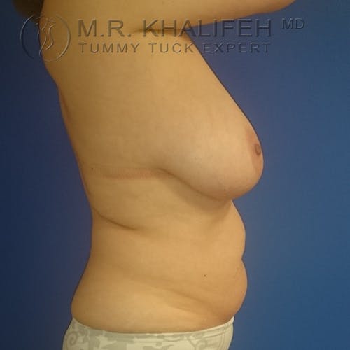 Tummy Tuck Gallery - Patient 3762414 - Image 5