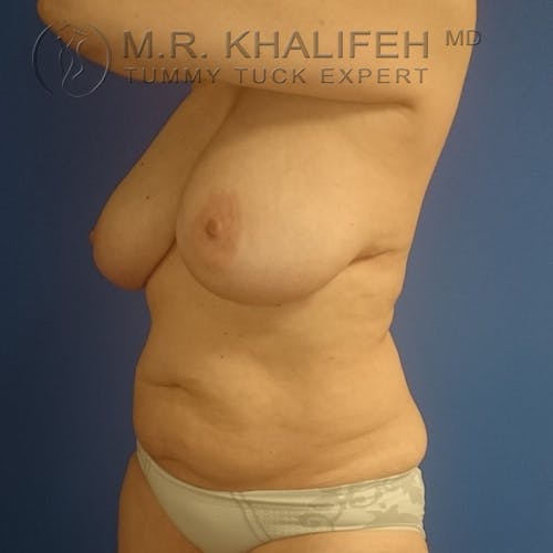 Tummy Tuck Gallery - Patient 3762414 - Image 7