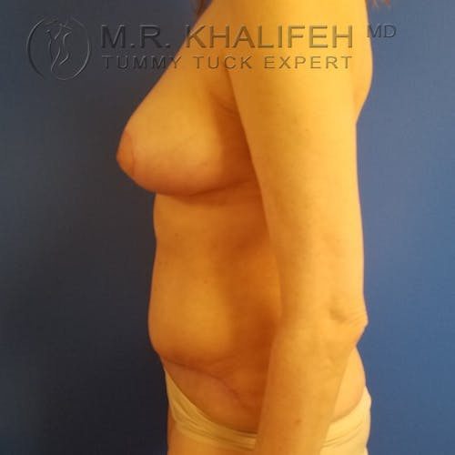 Tummy Tuck Gallery - Patient 3762414 - Image 10
