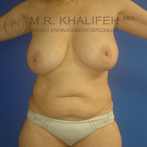 Mommy Makeover Gallery - Patient 3762589 - Image 1