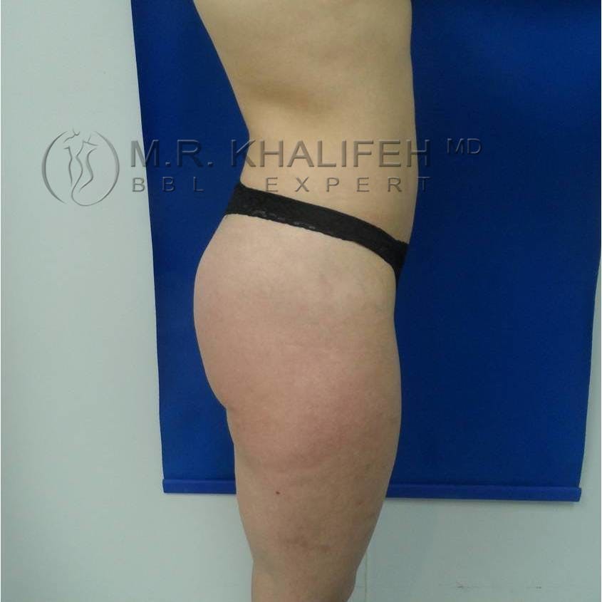 Brazilian Buttock Lift Gallery - Patient 3762587 - Image 8