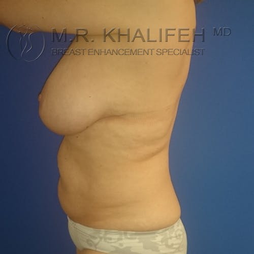 Mommy Makeover Gallery - Patient 3762589 - Image 9