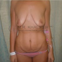 Mommy Makeover Gallery - Patient 3762590 - Image 1