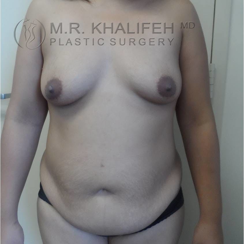 Mommy Makeover Gallery - Patient 3762611 - Image 1