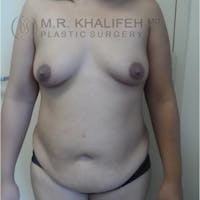 Mommy Makeover Gallery - Patient 3762611 - Image 1