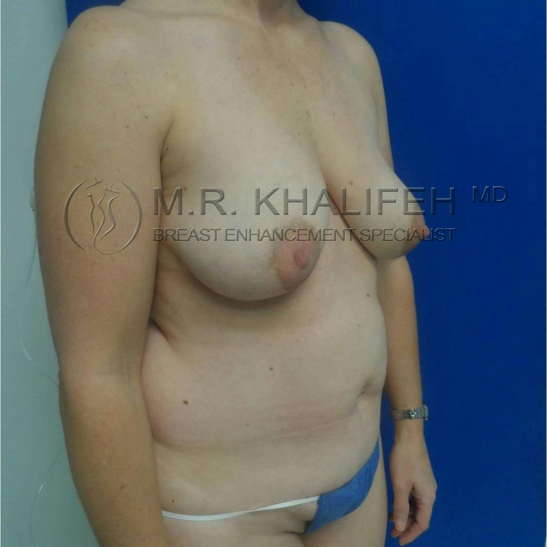 Mommy Makeover Gallery - Patient 3762613 - Image 9