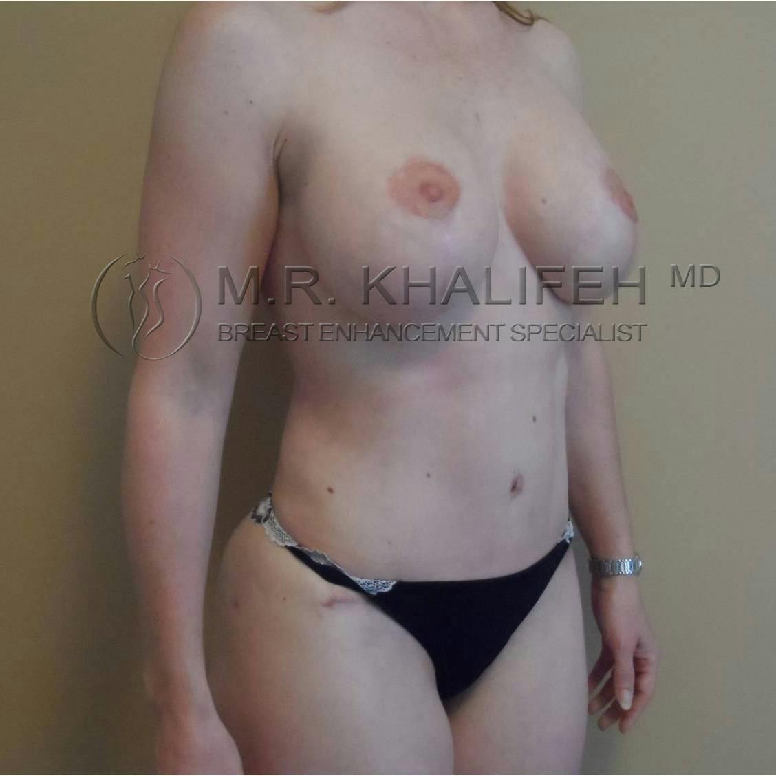 Mommy Makeover Gallery - Patient 3762613 - Image 10