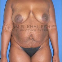 Mommy Makeover Gallery - Patient 3762616 - Image 1