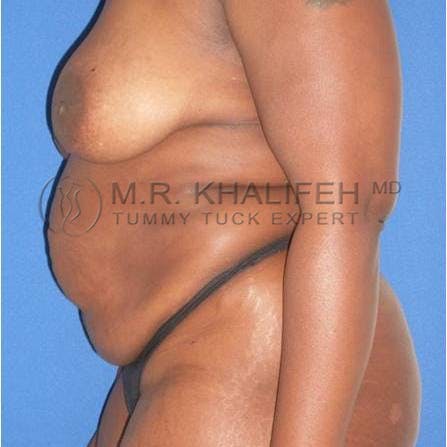 Mommy Makeover Gallery - Patient 3762616 - Image 3