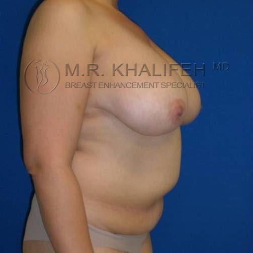 Mommy Makeover Gallery - Patient 3762618 - Image 1