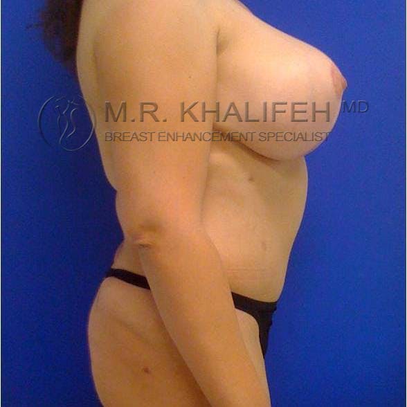 Mommy Makeover Gallery - Patient 3762618 - Image 2