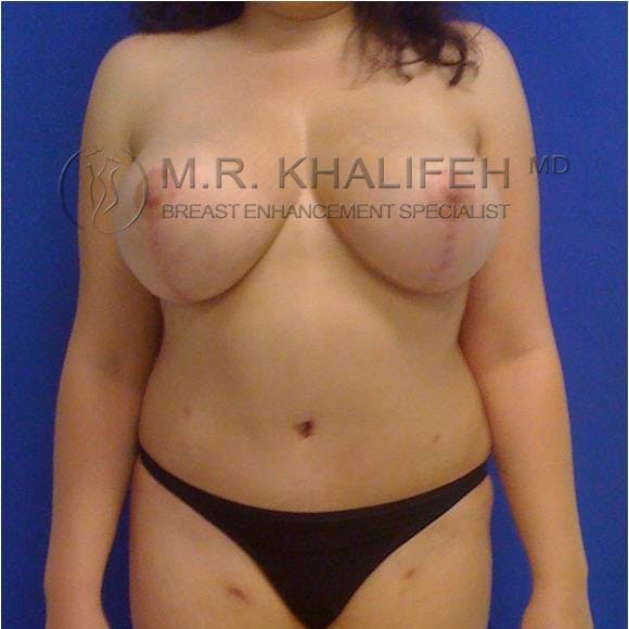 Mommy Makeover Gallery - Patient 3762618 - Image 4