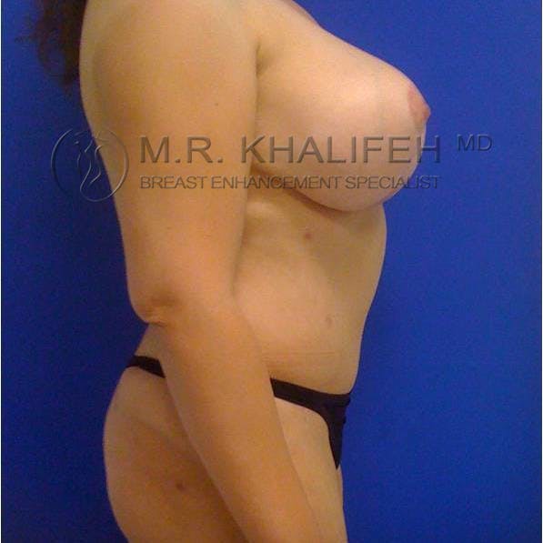 Mommy Makeover Gallery - Patient 3762618 - Image 6
