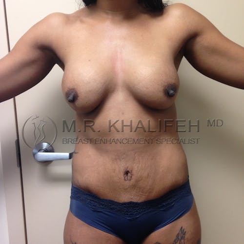 Mommy Makeover Gallery - Patient 3762683 - Image 2