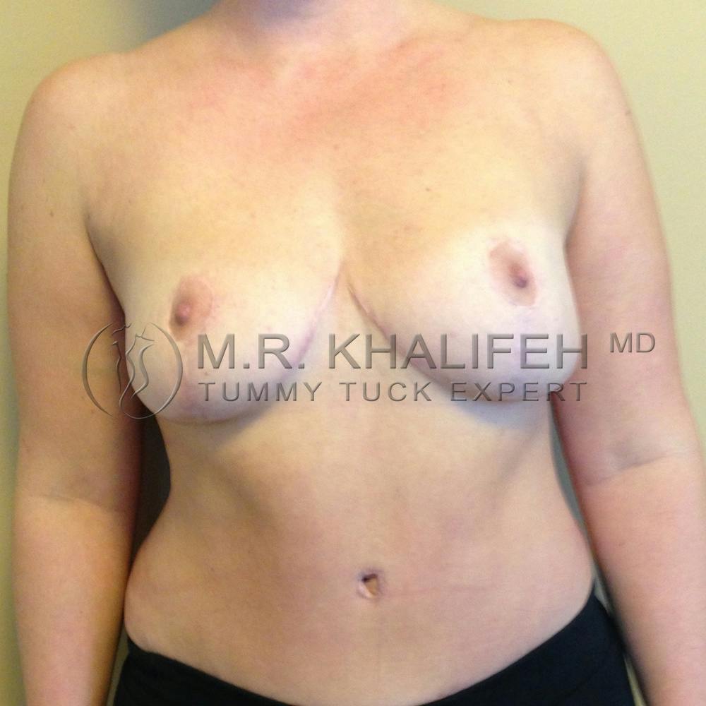 Mommy Makeover Gallery - Patient 3762756 - Image 2