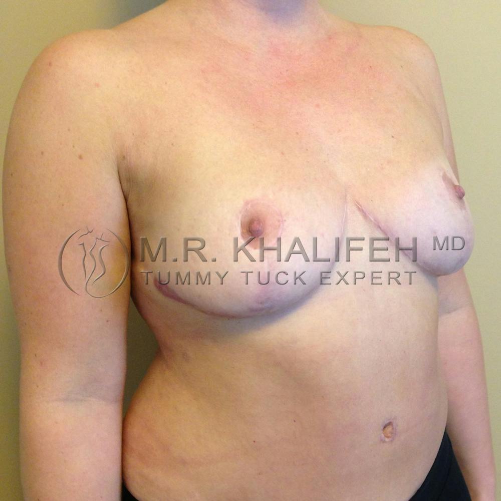 Mommy Makeover Gallery - Patient 3762756 - Image 6