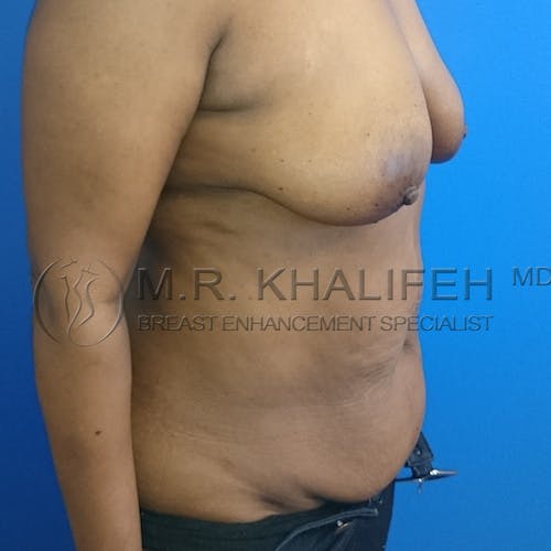Mommy Makeover Gallery - Patient 3762826 - Image 3