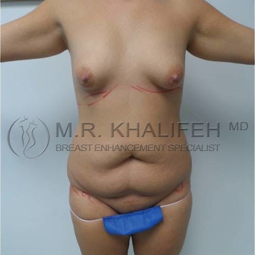 Mommy Makeover Gallery - Patient 3762873 - Image 1
