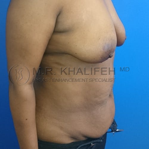 Mommy Makeover Gallery - Patient 3762977 - Image 3