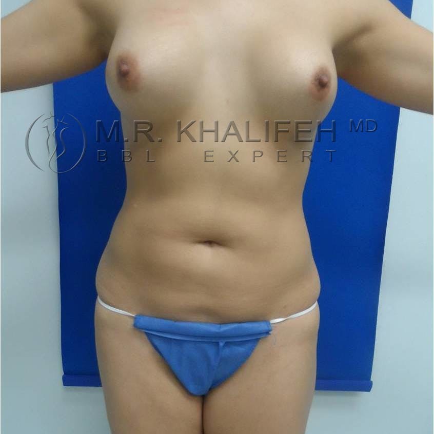 Abdominal Liposuction Gallery - Patient 94080927 - Image 1